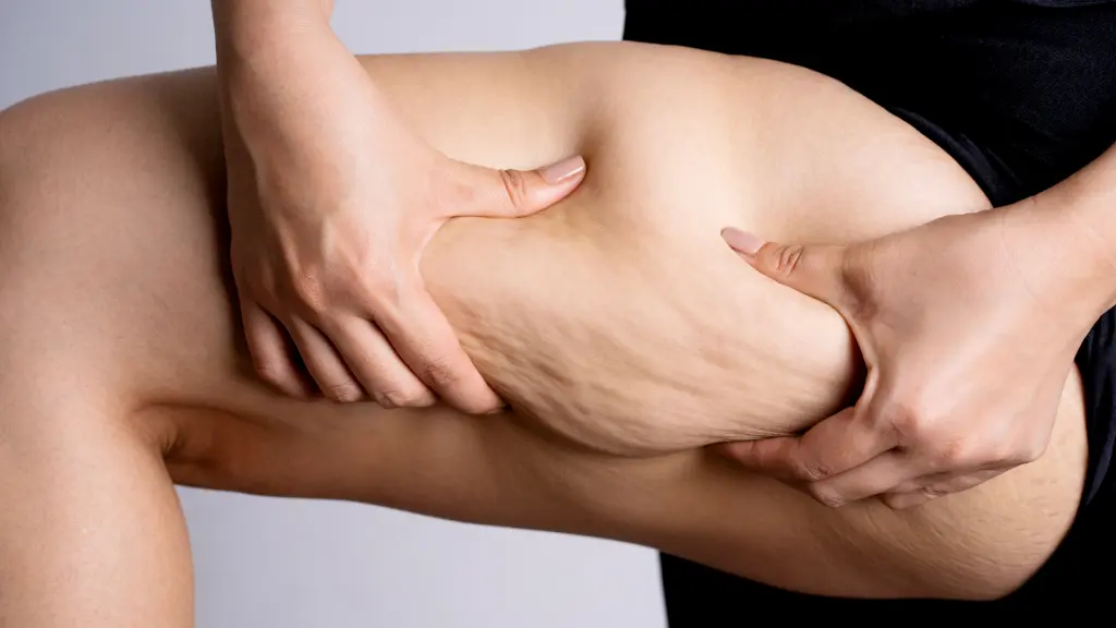 Intralipoterapia a Pisa: una tecnica efficace contro gli accumuli adiposi localizzati