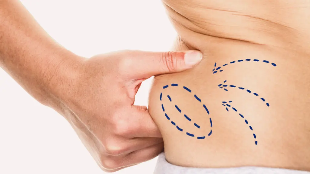 Mesoterapia